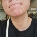 새로나병원 | [공지] 피부과 여드름 치료 마지막 후기/심한 여드름 극복/내돈내산