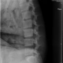 L-Spine Lateral (Flexion) 이미지