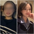 얼굴캣 닥터손유나의원 윤곽주사 4회차 내돈내산 솔직후기