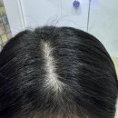 안양금융센터 앞 | 안양 두피관리 범계 웰킨두피탈모센터 안양점 두피 스케일링 후기