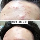 인체의 면역력을 높이는 방법( 감기나 코로나바이러스나 조류 독감이나 매르스나 사스와 같은 전염성 질환이나 아토피와 여드름과 모낭염과 질염 등 대응) 이미지