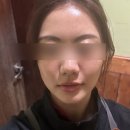 신논현역 리쥬란힐러 볼륨효과 + 물광까지 같이 들어가는 쥬블리주사 후기 feat. 스킨보톡스 수면마취