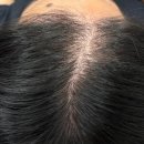 두피가 비어보일때 찾아가야할 분당smp 잘하는 곳! &#34;헤드샷스칼프 본점&#34;