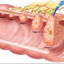 대장암 3기를 극복한 어느 환자의 투병 과정 이미지