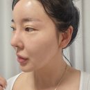 안산피부과 필로드 쁨클리닉 시술 후 변화: 홍조 사라지고 피부 탄력 UP!