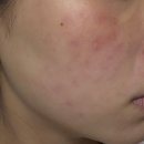 멤버쉽풀 | 리쥬란 4cc 부작용+효과 다 겪은 후기(가스마취/리쥬란본사멤버쉽강남피부과)