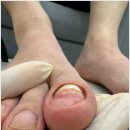 무드비네일닥터아이티엔내성발톱무좀발각질