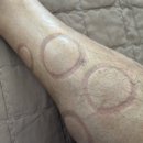 열린치유한의원 | 마라톤 다리 신스프린트 부상, 3개월의 고생 끝에 찾은 한의원 치료 희망?