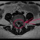 (허리디스크 치료사례-10 조*희님 요추 4-5번간 추간판 탈출증(치료전-후MRI비교) 이미지