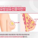 유방 혹 원인에 대해 알아보자 이미지