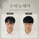 수하늘 헤어 | 남자 탈모 증모술 잘하는 곳? 남자 정수리 탈모 자연스럽게 볼륨을 살리는 방법! 수하늘헤어 증모술 후기!