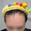 30대 여성의 헤어라인 smp 찐만족 후기 : 하남smp 블랙아트