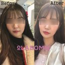 라보미의원 네이버블로그
