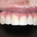 예성윤치과의원 | 아래앞니 부분교정+ 앞니크라운 실제 후기, 거여 이아소치과