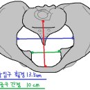 쌈지부전 | 여성건강간호학4 - 고위험임신, 고위험분만(미완성)