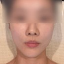 원스킨앤더타이 | 민스킨&amp;바디 | 웨딩축소관리로 얼굴 뿌시고 온 후기