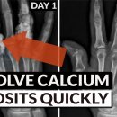 Reverse Soft Tissue Calcification 이미지