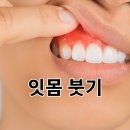 아플때약국 | 잇몸 붓고 아플때 잇몸 염증 약국 약 추천 알아보자