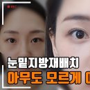 [4K] 이제 카메라 무섭지 않아요! 눈밑지방재배치 다크 개선과정 수술 후 3개월, 밀착 인터뷰! 이미지