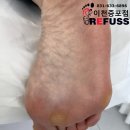 레푸스증포