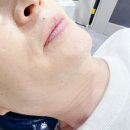 홍대역피부과 젠틀맥스프로플러스 남자수염 제모 후기!
