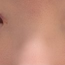 젤리멍 | [눈밑지 기록③] 눈밑지 2일차부터 실밥 제거까지, 붓기·멍 변화 후기