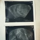 조윤영여성의원 | 자궁외임신 난관절제술 후기 (양정분산부인과)