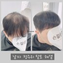 면목천로 | [서울/중랑구] 남자 정수리 탈모, 한올 증모술 커버 후기