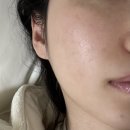 라비아의원 | 건대 라비아의원 피코토닝 5회차 기미잡티 제거 후기