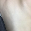 사상체질건강원 | 만성 성인여드름 극복한 썰 (시술X)