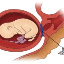 조산 이미지
