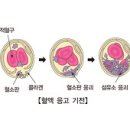 파종성 혈관내 응고 증후군 (Diffuse or disseminated intravascular coagulation) 이미지