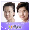 압구정서울성형외과 네이버블로그