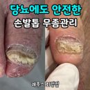 레푸스 화정점 이미지