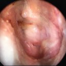 재천 | 고막 재천공, 고막 패치술 후기 #3
