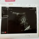 김천제일병원 | 콩떡이가 태어났어요❤️ 김천제일병원 출산 후기