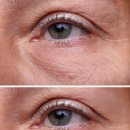 이미지업의원 | 중년성형, 안면거상술 회복기간 앞당기고 싶다면 <병원장 작성>