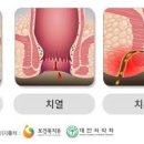 항문 가려움 원인 및 해결항문 소양증 치료 이미지