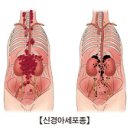 신경아세포종 (Neuroblastoma) 이미지