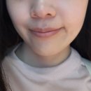 드림라인치과교정과치과의원 | 주걱턱 교정비용 및 성인 비수술 7개월차 후기