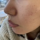 퉁이네 | [인천] 영종도 운서역 피부과 포텐자+쥬베룩 3cc 후기