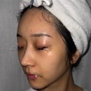 장이비인후과의원 | 피부 트러블과 가려움으로 잠실 지연성 음식 알러지 검사한 후기, KB손보 실비 청구 비용