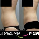 [네이버카페사진후기 By 난날씬님][허벅지/복부/팔]복부지방흡입전후사진 이미지