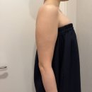 멍 | [팔뚝 무한람스 1~2주차] 통증 · 멍 · 붓기 후기 + 체중 변화 정리