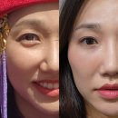 청담약국 | 청담피부과 포텐자 + 줄기세포 피부주사 내돈내산 일주일 후기