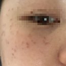 서울루비 | [서울] 종로 피부과 루비 레이저, 레블라이트 토닝 주근깨 레이저 후기 및 전후비교