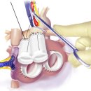 선천성 심장병 수술[congenital cardiac surgery] 이미지