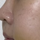 더 귀족 | 강남 귀족수술 팔자주름 보형물 내돈내산 후기 일주일차[1-7일]