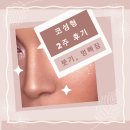 대구 라인성형외과의원 코 성형 2일차 1주차 후기