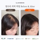 강남두피문신 티 안 나고 자연스럽게 변신한 후기